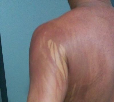 Turista que teve manchas no corpo aps banho de mar na Bahia  internado em hospital
