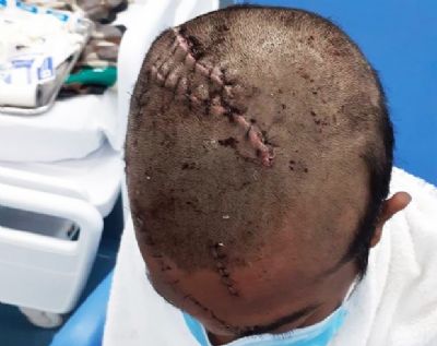 Indgena atacado por ona-pintada passa por cirurgia na cabea e segue internado