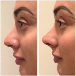 Juju Salimeni mostra antes e depois aps 'empinadinha' no nariz