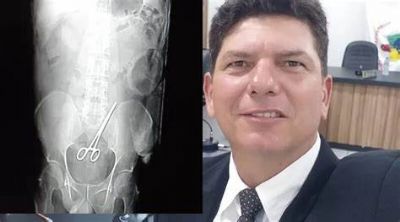 Vereador de MT passa por nova cirurgia aps mdicos esquecerem tesoura dentro da barriga