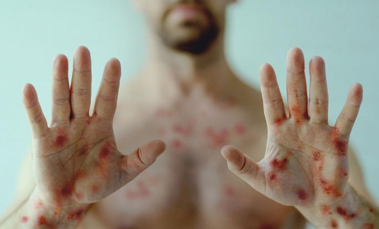 Homem � diagnosticado com HIV, Covid e var�ola do macaco na It�lia