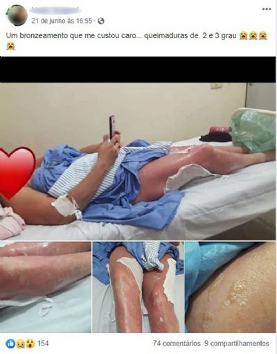 Mulher tem 75% do corpo queimado ao fazer bronzeamento