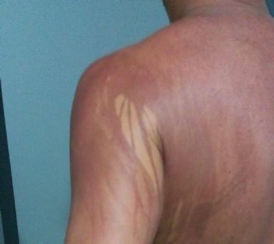 Turista que teve manchas no corpo ap�s banho de mar na Bahia � internado em hospital