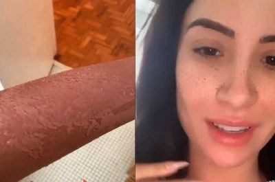 Blogueira sofre queimaduras ap�s confundir bronzeador com protetor