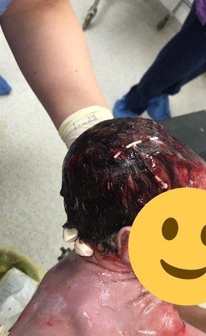 ​Beb� nasce com DIU preso no cabelo. M�dico explica o caso