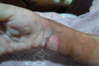 Celular explode e m�e encontra menina de 5 anos �em chamas�